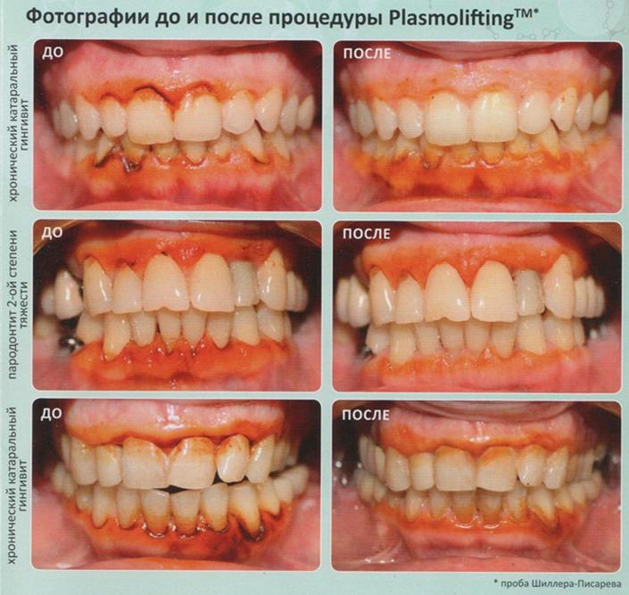 Фотографии до и после процедуры PlasmliftingTM